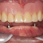 dentures in Gibsonia, FL