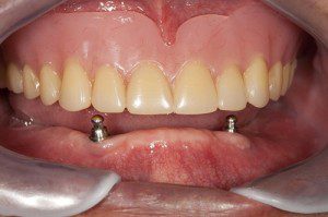 dentures in GibsoniaFL