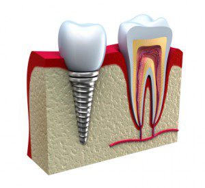GettyImages_177257483-Dental Implants