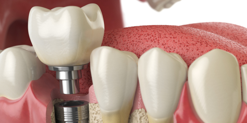 product that is getting a lot of information are dental implants