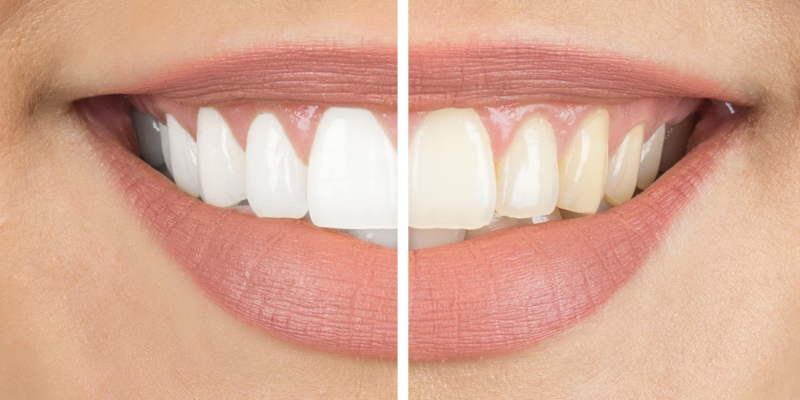 best and most effective teeth whitening