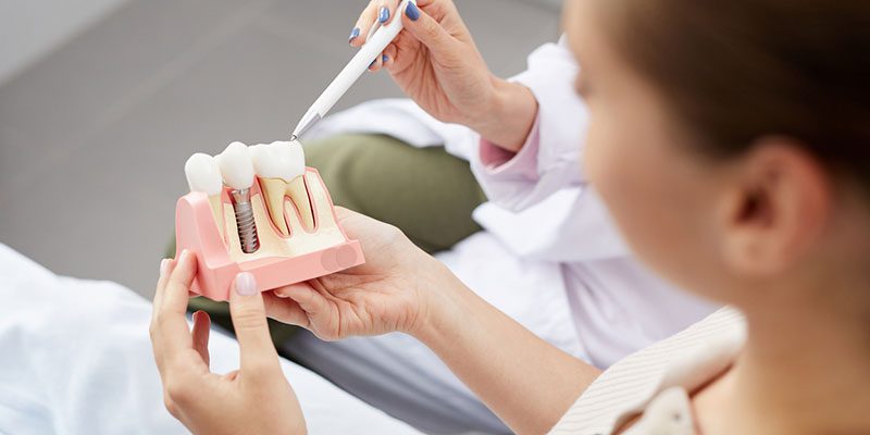 Dental Implants: Everything You Need to Know 
