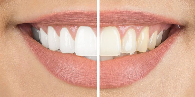 Why You'll Love Your New Smile After Teeth Whitening