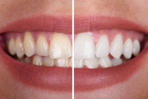 3 Benefits of Tooth Whitening