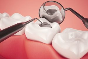 What You Need to Know About Tooth Fillings