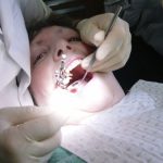 Wisdom Tooth Extraction in Lakeland, Florida