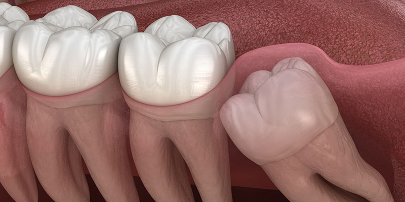 Here’s Why Wisdom Tooth Extraction is Important for Your Oral Health