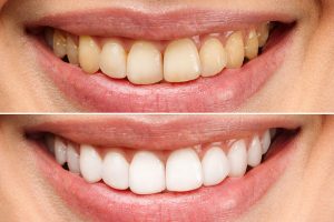 Debunking Common Tooth Whitening Myths